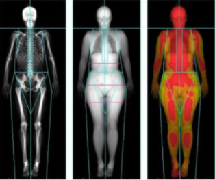 Análisis de composición corporal con Hologic Horizon